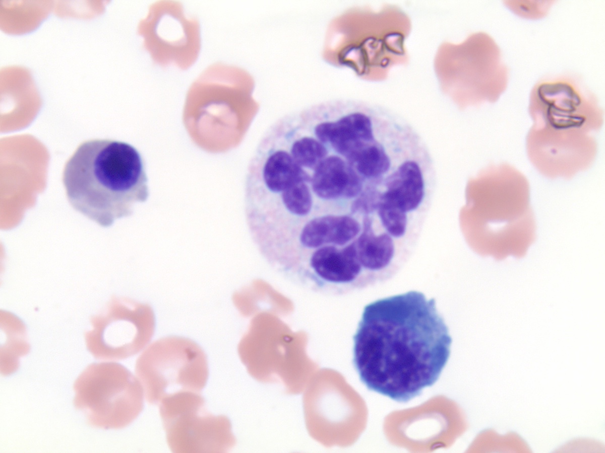 Hypersegmented neutrophil, bone marrow 1000x